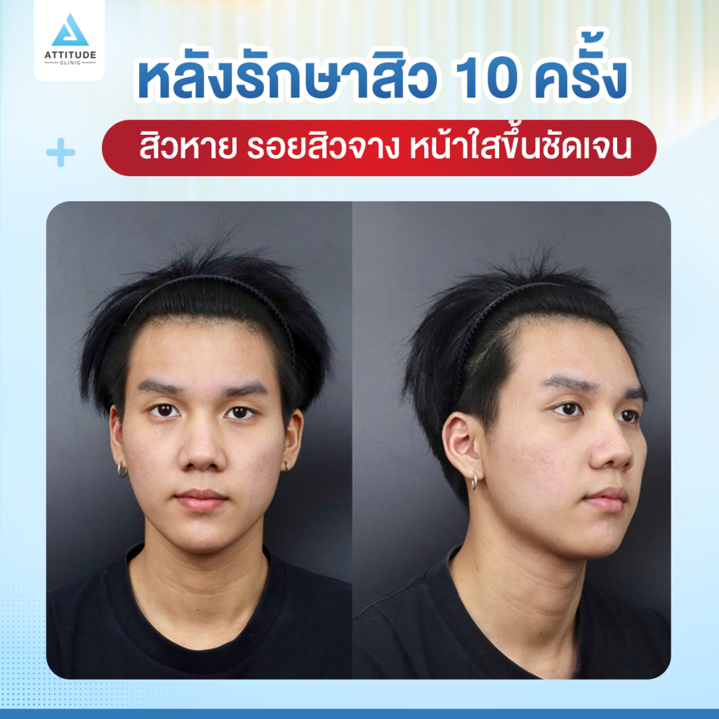 เคยเป็นสิวแต่ตอนนี้หายแล้ว เพราะมี Attitude Clinic เป็นตัวช่วยเรื่องผิวใส