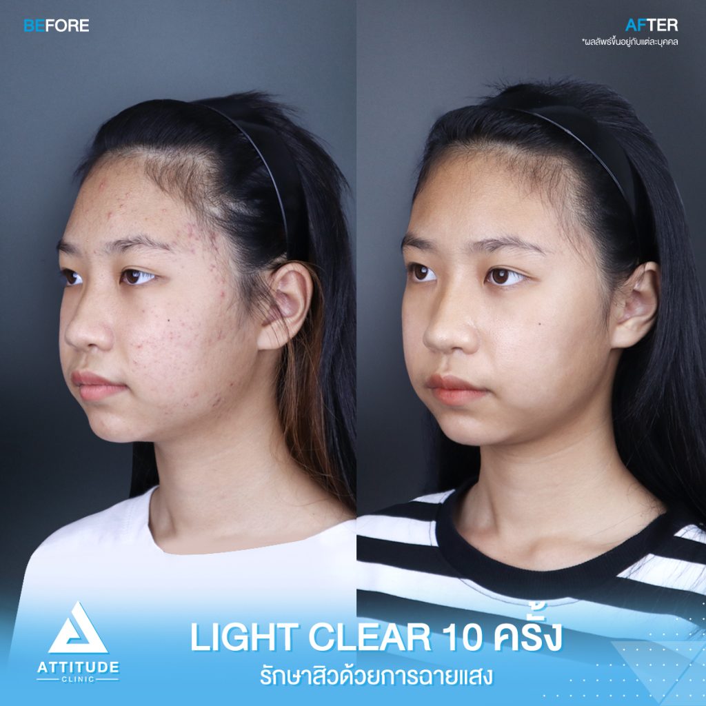 สิวเยอะแค่ไหนก็ไม่กลัว! รีวิวรักษาสิวด้วยการฉายแสงโปรแกรม Light Clear 7 ขั้นตอน จำนวน 10 ครั้ง ของน้องนิธิกานต์ มีปัญหาสิวและรอยสิวจัดเต็ม