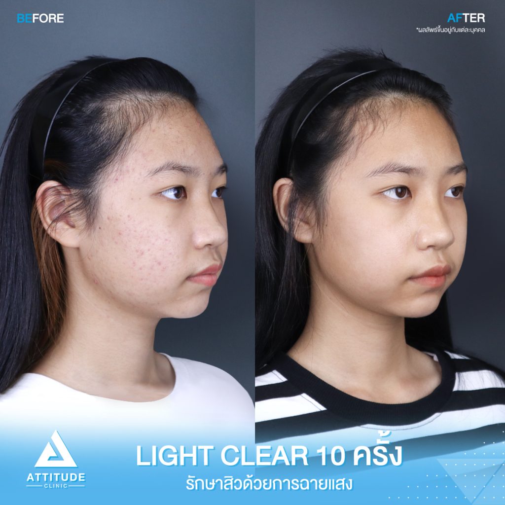 สิวเยอะแค่ไหนก็ไม่กลัว! รีวิวรักษาสิวด้วยการฉายแสงโปรแกรม Light Clear 7 ขั้นตอน จำนวน 10 ครั้ง ของน้องนิธิกานต์ มีปัญหาสิวและรอยสิวจัดเต็ม