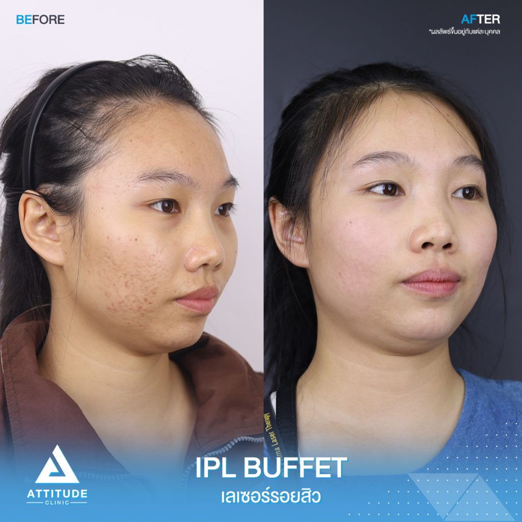 รอยสิว ผิวไม่เรียบ IPL ช่วยได้ รีวิวเลเซอร์หน้าใส Cellec V IPL บุฟเฟต์ตลอด 1 ปีเต็ม ของน้องทิพย์ ที่มีปัญหารอยสิวกวนใจ หน้าไม่ใส ไม่เรียบเนียน หลังทำเลเซอร์ตอนนี้หน้าใสวิ้ง ผิวเรียบเนียนขึ้น มั่นใจขึ้นสุดๆ