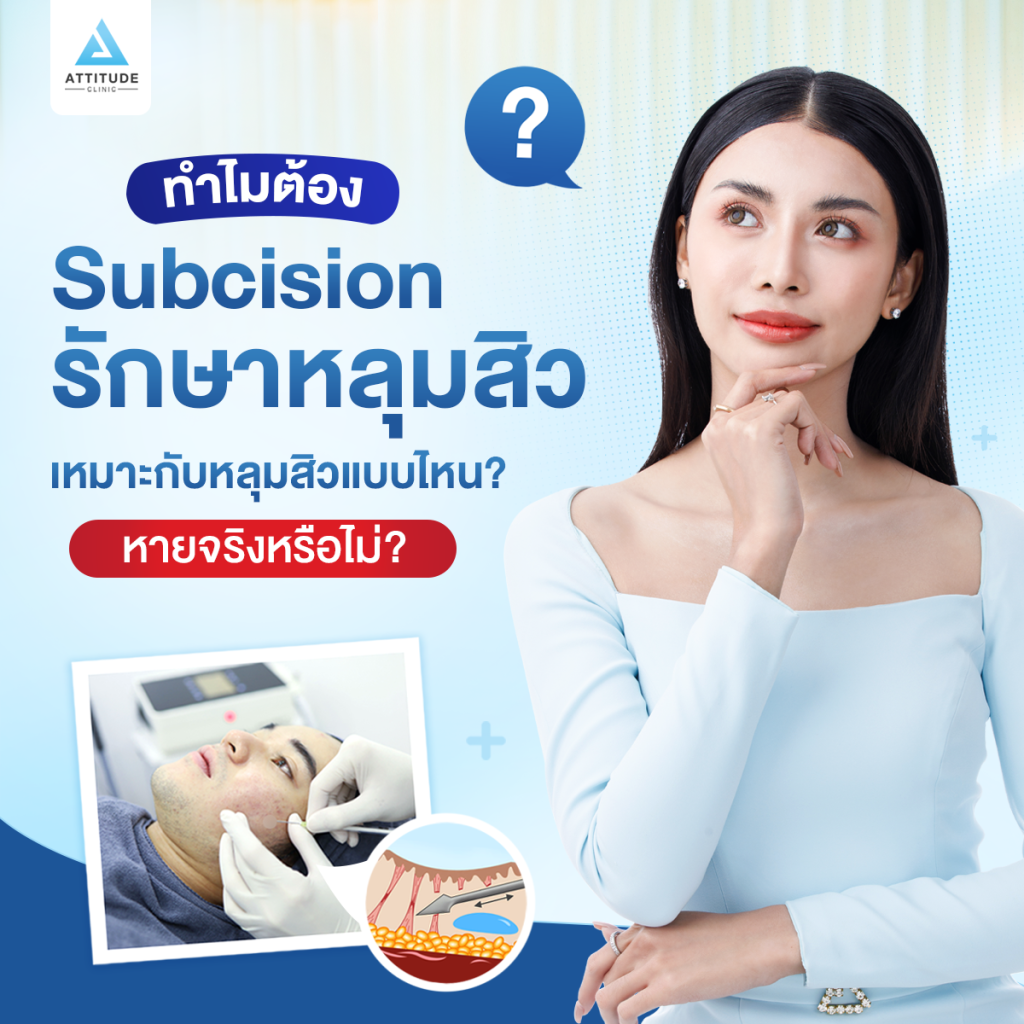 ทำไมรักต้องรักษาสิว Subcision เหมาะกับหลุมสิวแบบไหน? หายจริงหรือไม่?