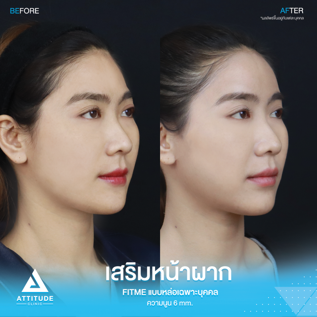 รีวิวเสริมหน้าผากคุณบุ๋ม S Curve หน้าผากสวยมาก ตีให้ตายก็ไม่โป๊ะ รีวิวเสริมหน้าผากคุณบุ๋ม S Curve ซิลิโคน Fitme แบบหล่อเฉพาะบุคคล แก้ปัญหาหน้าผากแบน ผิวไม่เรียบเสมอกัน โหนกคิ้วสูงจากอายุที่เพิ่มขึ้น ให้สวยหวานละมุนโดยหมอยุ้ย