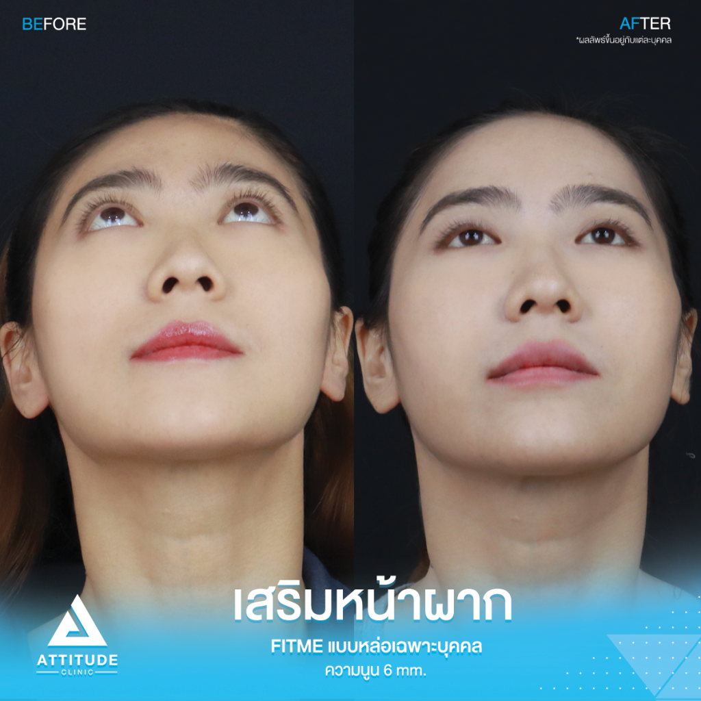 รีวิวเสริมหน้าผากคุณบุ๋ม S Curve หน้าผากสวยมาก ตีให้ตายก็ไม่โป๊ะ รีวิวเสริมหน้าผากคุณบุ๋ม S Curve ซิลิโคน Fitme แบบหล่อเฉพาะบุคคล แก้ปัญหาหน้าผากแบน ผิวไม่เรียบเสมอกัน โหนกคิ้วสูงจากอายุที่เพิ่มขึ้น ให้สวยหวานละมุนโดยหมอยุ้ย
