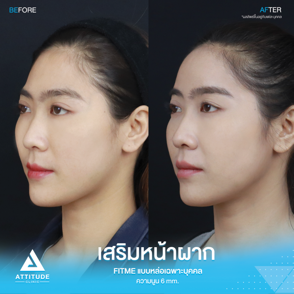 รีวิวเสริมหน้าผากคุณบุ๋ม S Curve หน้าผากสวยมาก ตีให้ตายก็ไม่โป๊ะ รีวิวเสริมหน้าผากคุณบุ๋ม S Curve ซิลิโคน Fitme แบบหล่อเฉพาะบุคคล แก้ปัญหาหน้าผากแบน ผิวไม่เรียบเสมอกัน โหนกคิ้วสูงจากอายุที่เพิ่มขึ้น ให้สวยหวานละมุนโดยหมอยุ้ย
