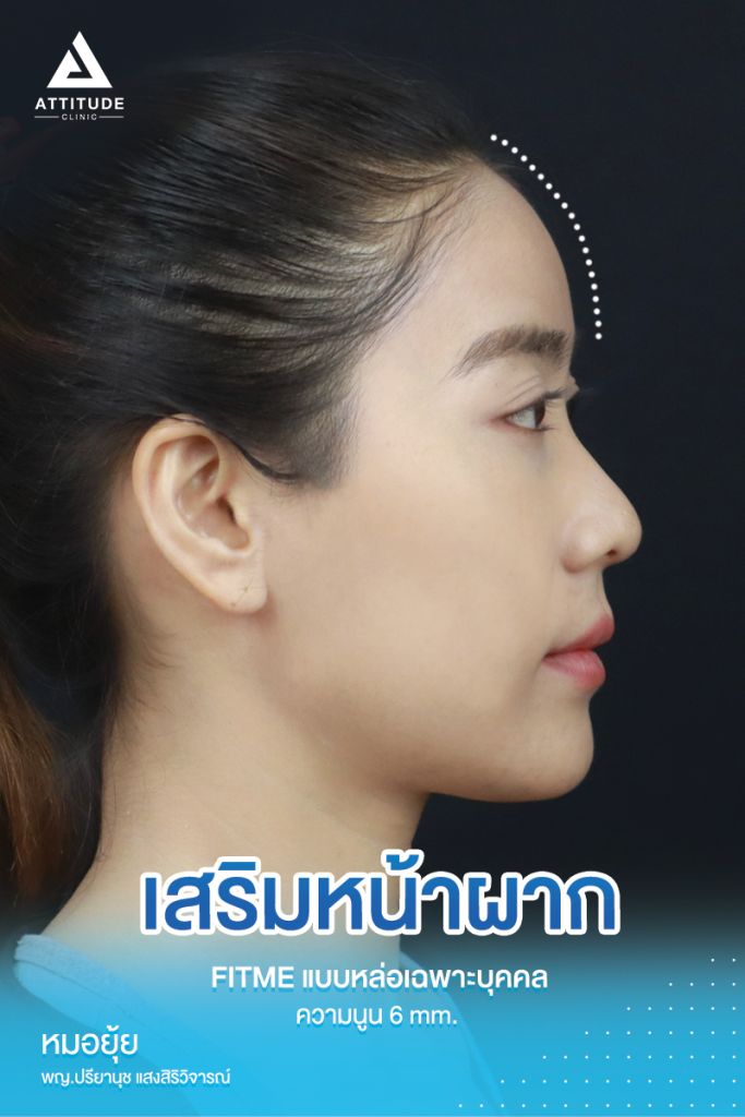หน้าผากสวยมาก ตีให้ตายก็ไม่โป๊ะ รีวิวเสริมหน้าผากคุณบุ๋ม S Curve ซิลิโคน Fitme แบบหล่อเฉพาะบุคคล แก้ปัญหาหน้าผากแบน ผิวไม่เรียบเสมอกัน โหนกคิ้วสูงจากอายุที่เพิ่มขึ้น ให้สวยหวานละมุนโดยหมอยุ้ย
