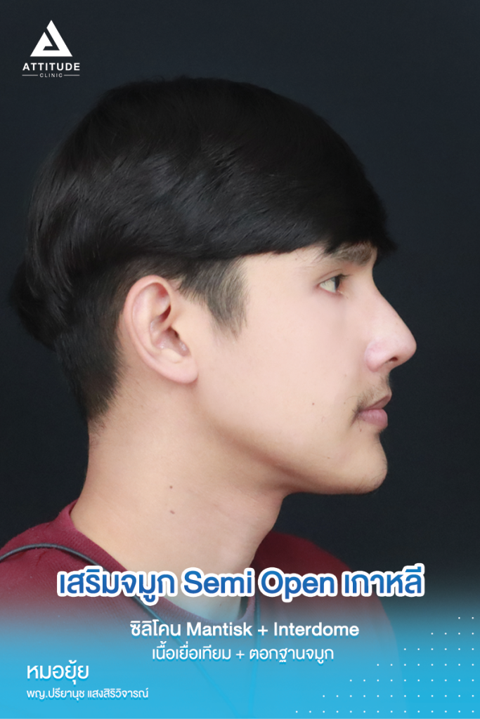 ฮัมพ์สูงแค่ไหน ก็เสริมให้หล่อได้ รีวิวเสริมจมูกคุณเจมส์เทคนิค Semi Open เกาหลี ซิลิโคน Mantisk พร้อมปรับฐานจมูก แก้ฮัมพ์ก่อนเสริม หมอยุ้ย Attitudce Clinic รัชดา