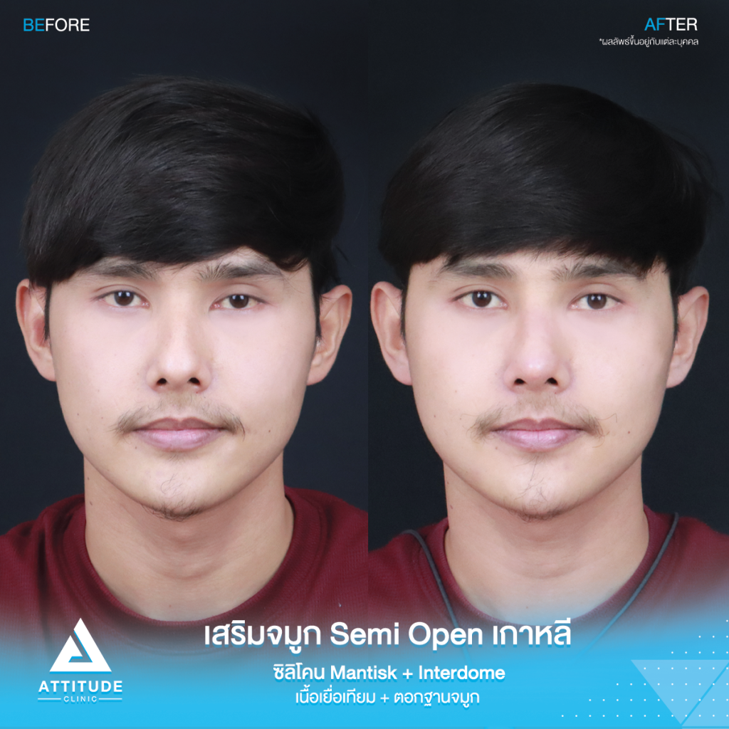 ฮัมพ์สูงแค่ไหน ก็เสริมให้หล่อได้ รีวิวเสริมจมูกคุณเจมส์เทคนิค Semi Open เกาหลี ซิลิโคน Mantisk พร้อมปรับฐานจมูก แก้ฮัมพ์ก่อนเสริม หมอยุ้ย Attitudce Clinic รัชดา