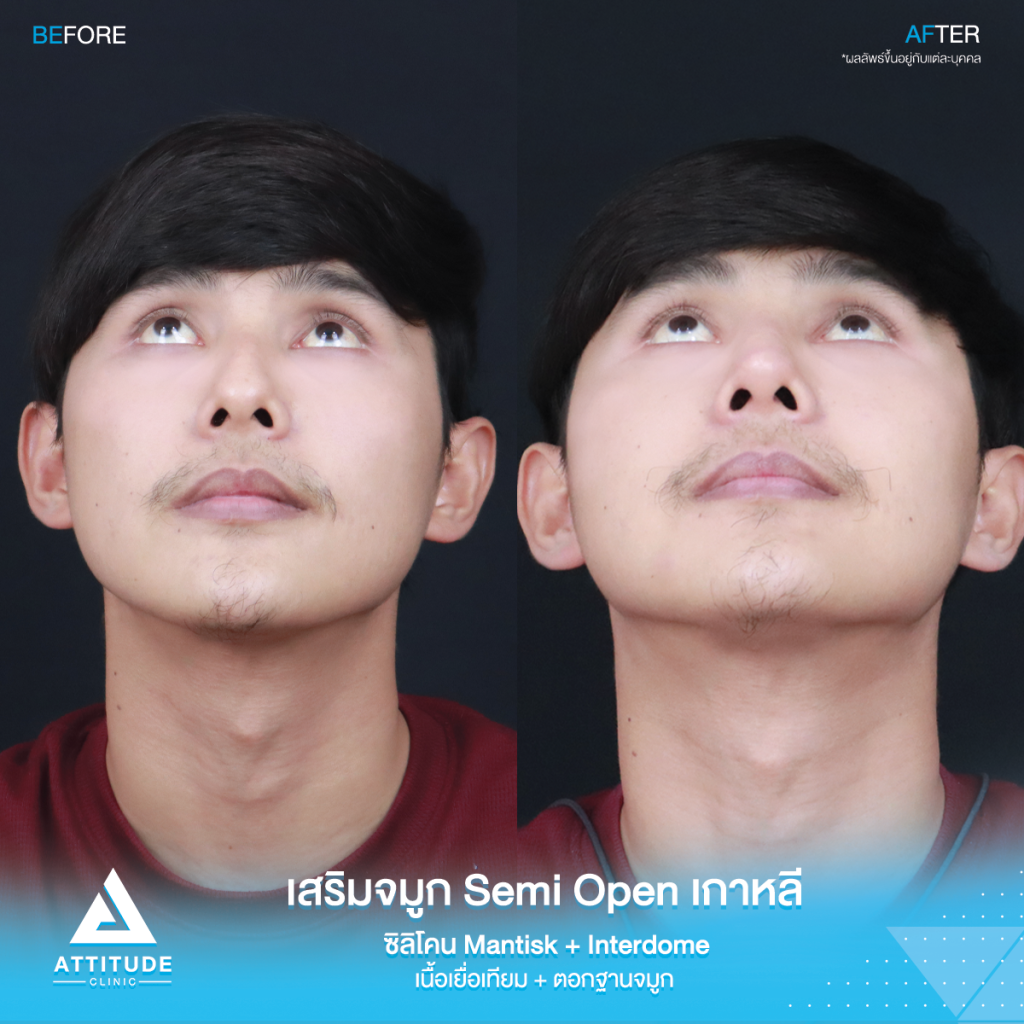 ฮัมพ์สูงแค่ไหน ก็เสริมให้หล่อได้ รีวิวเสริมจมูกคุณเจมส์เทคนิค Semi Open เกาหลี ซิลิโคน Mantisk พร้อมปรับฐานจมูก แก้ฮัมพ์ก่อนเสริม หมอยุ้ย Attitudce Clinic รัชดา