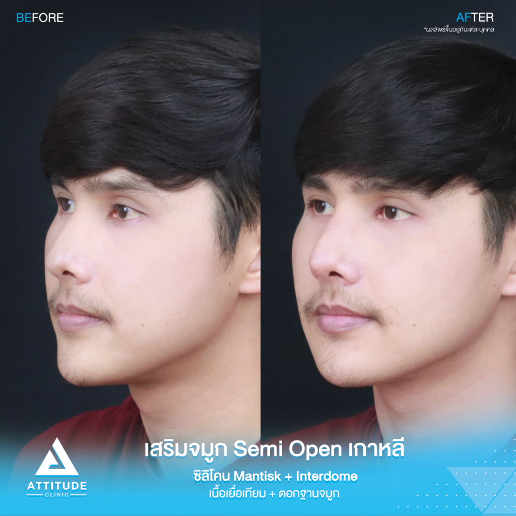 ฮัมพ์สูงแค่ไหน ก็เสริมให้หล่อได้ รีวิวเสริมจมูกคุณเจมส์เทคนิค Semi Open เกาหลี ซิลิโคน Mantisk พร้อมปรับฐานจมูก แก้ฮัมพ์ก่อนเสริม หมอยุ้ย Attitudce Clinic รัชดา