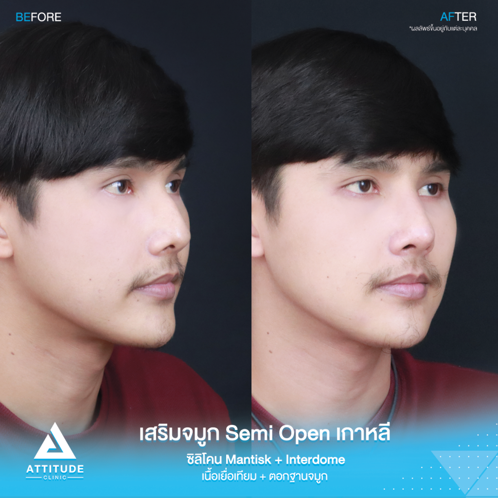 ซิลิโคน Maฮัมพ์สูงแค่ไหน ก็เสริมให้หล่อได้ รีวิวเสริมจมูกคุณเจมส์เทคนิค Semi Open เกาหลี ซิลิโคน Mantisk พร้อมปรับฐานจมูก แก้ฮัมพ์ก่อนเสริม หมอยุ้ย Attitudce Clinic รัชดาntisk แก้ปัญหา