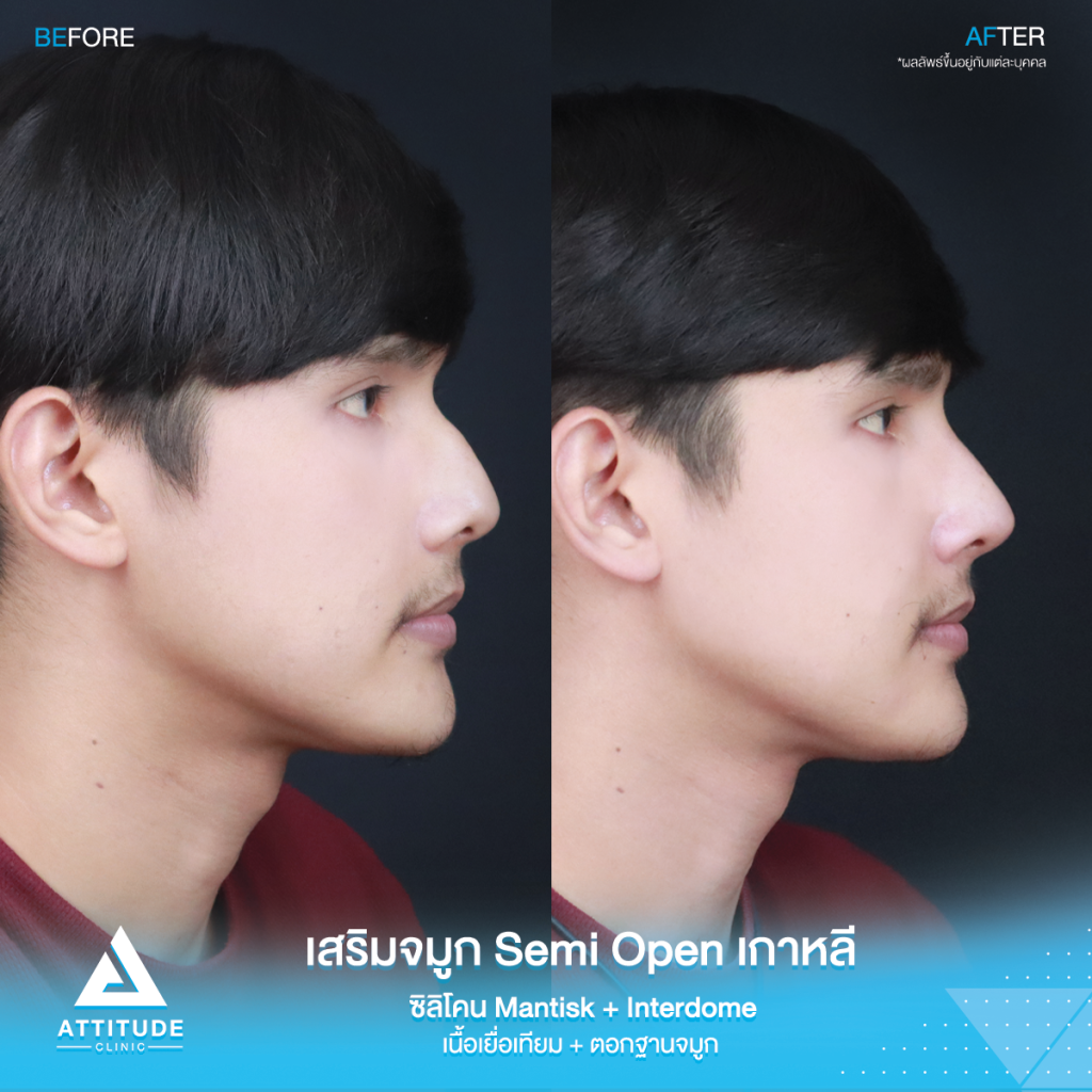 ฮัมพ์สูงแค่ไหน ก็เสริมให้หล่อได้ รีวิวเสริมจมูกคุณเจมส์เทคนิค Semi Open เกาหลี ซิลิโคน Mantisk พร้อมปรับฐานจมูก แก้ฮัมพ์ก่อนเสริม หมอยุ้ย Attitudce Clinic รัชดา