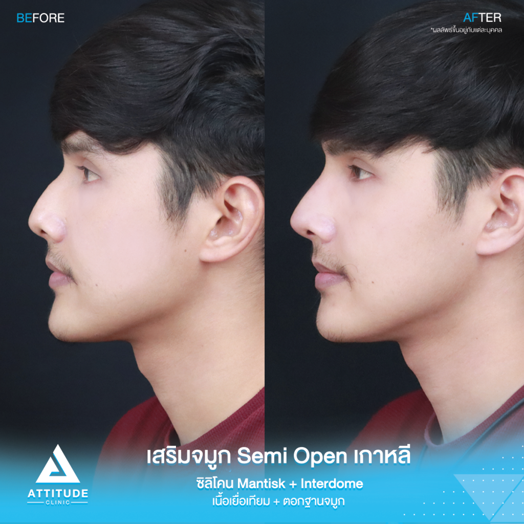 ฮัมพ์สูงแค่ไหน ก็เสริมให้หล่อได้ รีวิวเสริมจมูกคุณเจมส์เทคนิค Semi Open เกาหลี ซิลิโคน Mantisk พร้อมปรับฐานจมูก แก้ฮัมพ์ก่อนเสริม หมอยุ้ย Attitudce Clinic รัชดา