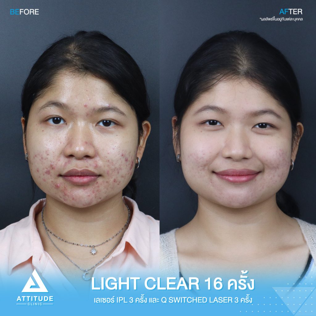 สิวไม่หาย ไม่ให้กลับ! รีวิวรักษาสิวด้วยการฉายแสง Light Clear 7 ขั้นตอน จำนวน 16 ครั้ง เลเซอร์หน้าใสลดรอยสิว IPL จำนวน 3 ครั้ง และเลเซอร์ลดจุดด่างดำ Q-Switched จำนวน 3 ครั้ง ของน้องแป้ง