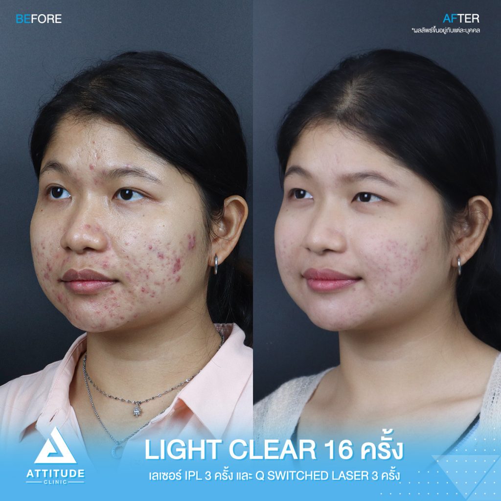 สิวไม่หาย ไม่ให้กลับ! รีวิวรักษาสิวด้วยการฉายแสง Light Clear 7 ขั้นตอน จำนวน 16 ครั้ง เลเซอร์หน้าใสลดรอยสิว IPL จำนวน 3 ครั้ง และเลเซอร์ลดจุดด่างดำ Q-Switched จำนวน 3 ครั้ง ของน้องแป้ง