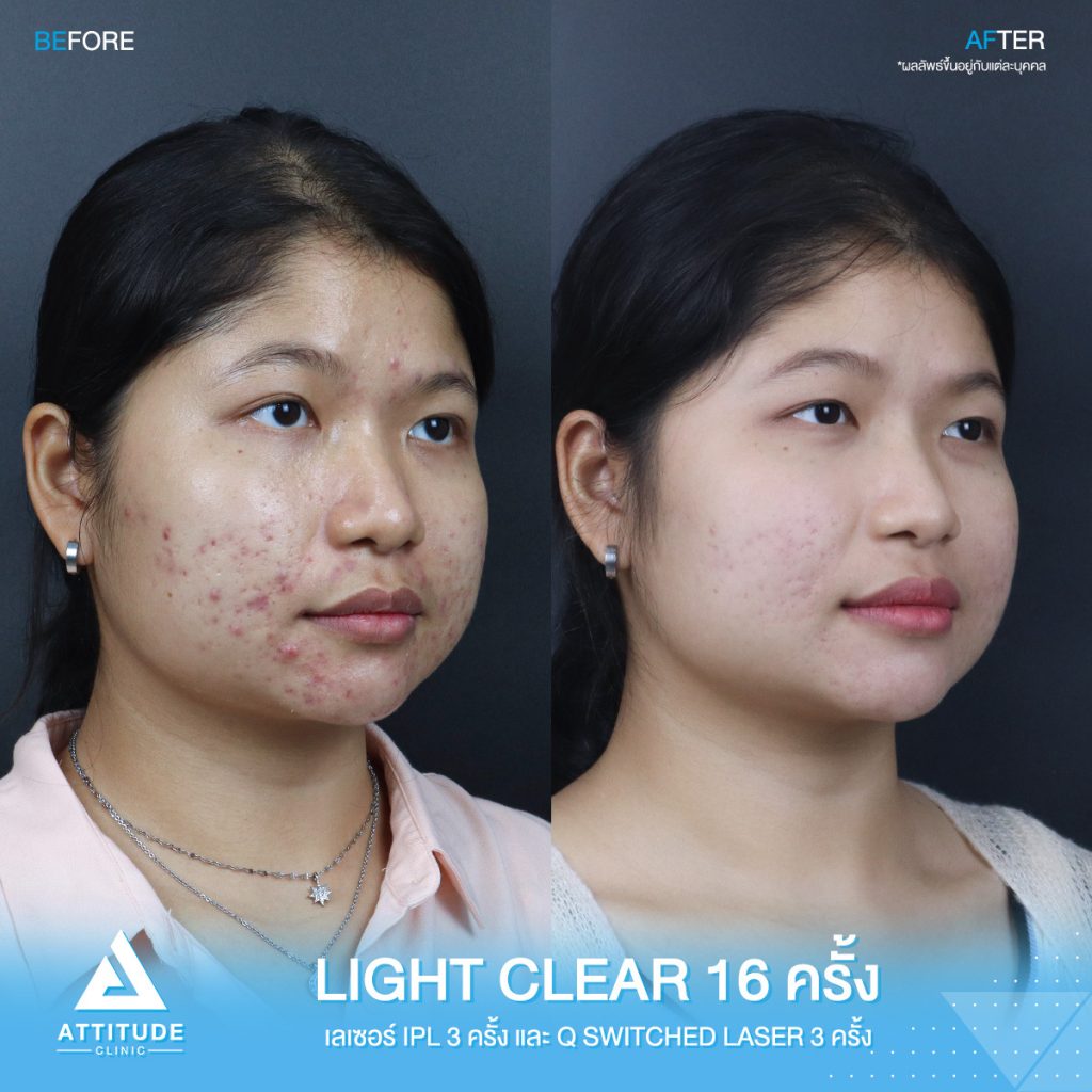 สิวไม่หาย ไม่ให้กลับ! รีวิวรักษาสิวด้วยการฉายแสง Light Clear 7 ขั้นตอน จำนวน 16 ครั้ง เลเซอร์หน้าใสลดรอยสิว IPL จำนวน 3 ครั้ง และเลเซอร์ลดจุดด่างดำ Q-Switched จำนวน 3 ครั้ง ของน้องแป้ง