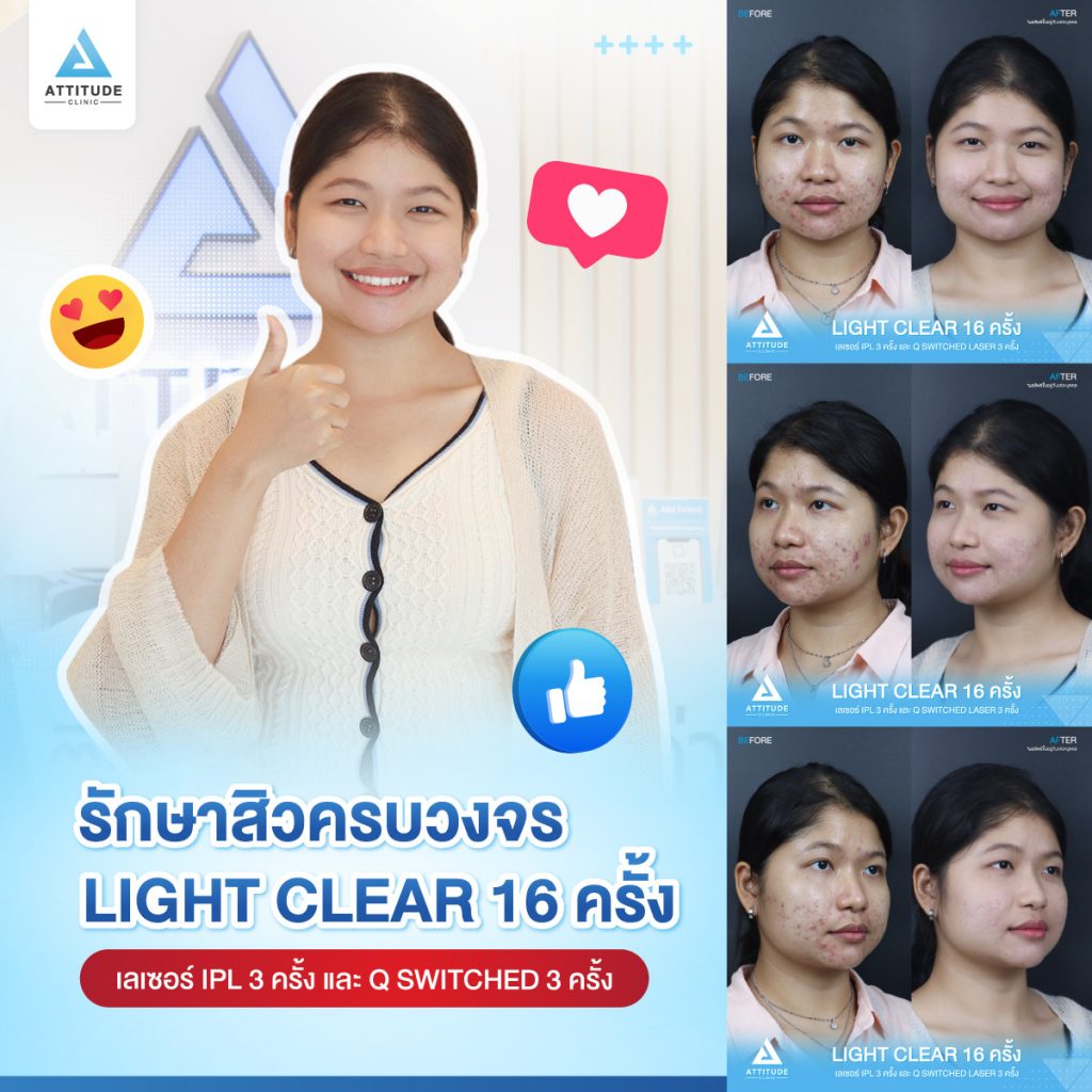 สิวไม่หาย ไม่ให้กลับ! รีวิวรักษาสิวด้วยการฉายแสง Light Clear 7 ขั้นตอน จำนวน 16 ครั้ง เลเซอร์หน้าใสลดรอยสิว IPL จำนวน 3 ครั้ง และเลเซอร์ลดจุดด่างดำ Q-Switched จำนวน 3 ครั้ง ของน้องแป้ง