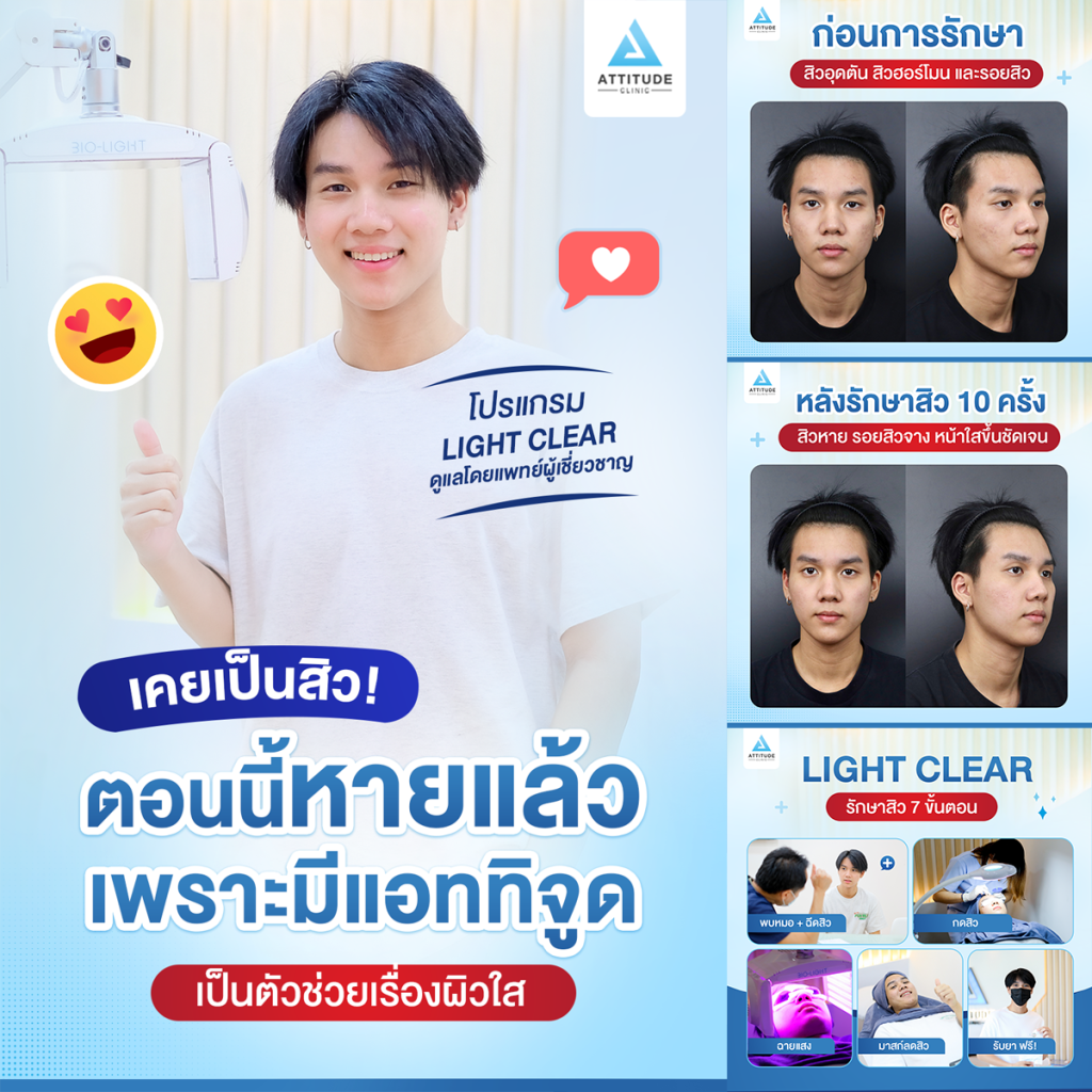 เคยเป็นสิวแต่ตอนนี้หายแล้ว เพราะมี Attitude Clinic เป็นตัวช่วยเรื่องผิวใส