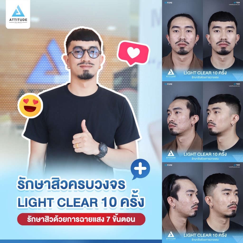 เปลี่ยนหนุ่มเซอร์ เป็นหนุ่มหน้าใส รีวิวรักษาสิวด้วยการฉายแสงโปรแกรม Light Clear 7 ขั้นตอน จำนวน 10 ครั้ง ของคุณนนท์ มีปัญหาสิวและรอยสิวจัดเต็ม