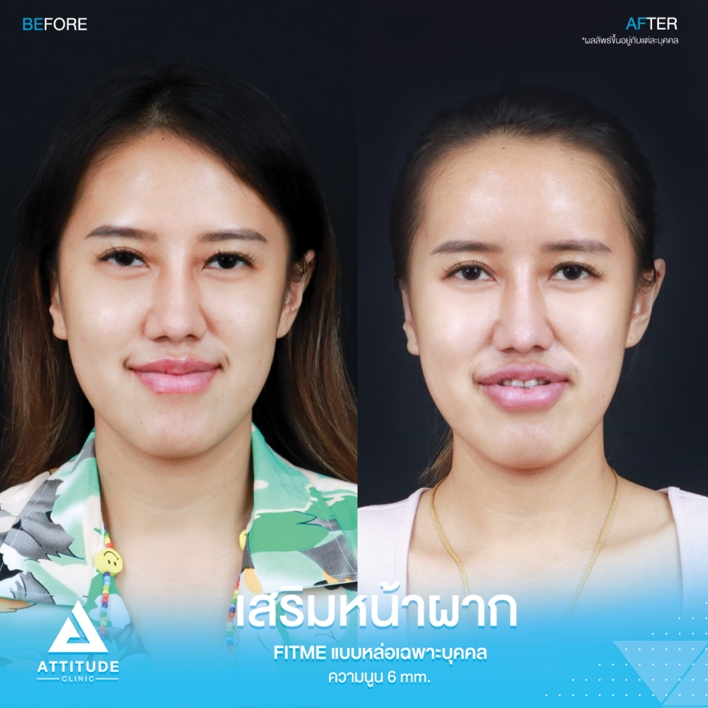 รีวิวเสริมหน้าผากคุณพลอย หน้าผากโค้งนูนสวย ปลอดภัยถาวร รีวิวเสริมหน้าผากคุณrพลอย S Curve ซิลิโคน Fitme แบบหล่อเฉพาะบุคคล ช่วงโหนกคิ้วสูง กลางหน้าผากมีร่องบุ๋ม โดยหมอยุ้ย Attitude Clinic รัชดา
