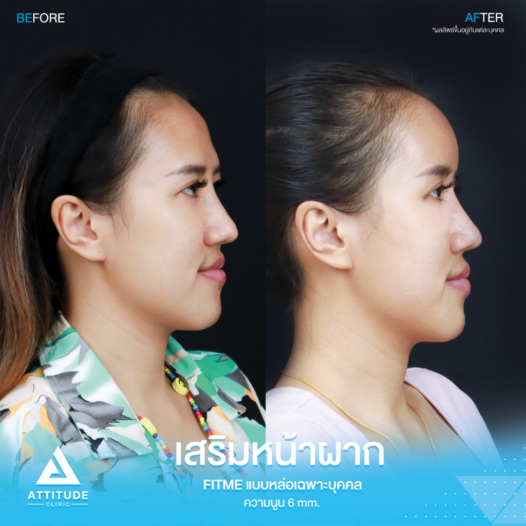 รีวิวเสริมหน้าผากคุณพลอย หน้าผากโค้งนูนสวย ปลอดภัยถาวร รีวิวเสริมหน้าผากคุณrพลอย S Curve ซิลิโคน Fitme แบบหล่อเฉพาะบุคคล ช่วงโหนกคิ้วสูง กลางหน้าผากมีร่องบุ๋ม โดยหมอยุ้ย Attitude Clinic รัชดา