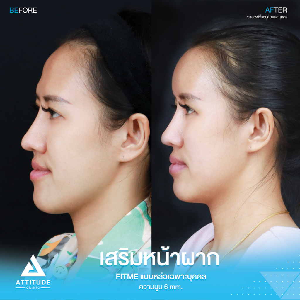 รีวิวเสริมหน้าผากคุณพลอย หน้าผากโค้งนูนสวย ปลอดภัยถาวร รีวิวเสริมหน้าผากคุณrพลอย S Curve ซิลิโคน Fitme แบบหล่อเฉพาะบุคคล ช่วงโหนกคิ้วสูง กลางหน้าผากมีร่องบุ๋ม โดยหมอยุ้ย Attitude Clinic รัชดา