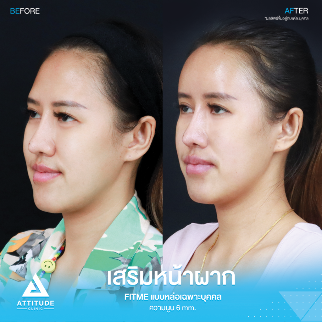 รีวิวเสริมหน้าผากคุณพลอย หน้าผากโค้งนูนสวย ปลอดภัยถาวร รีวิวเสริมหน้าผากคุณrพลอย S Curve ซิลิโคน Fitme แบบหล่อเฉพาะบุคคล ช่วงโหนกคิ้วสูง กลางหน้าผากมีร่องบุ๋ม โดยหมอยุ้ย Attitude Clinic รัชดา