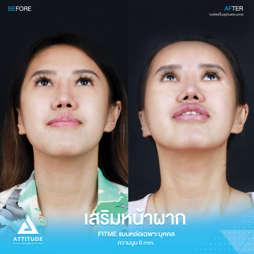 รีวิวเสริมหน้าผากคุณพลอย หน้าผากโค้งนูนสวย ปลอดภัยถาวร รีวิวเสริมหน้าผากคุณrพลอย S Curve ซิลิโคน Fitme แบบหล่อเฉพาะบุคคล ช่วงโหนกคิ้วสูง กลางหน้าผากมีร่องบุ๋ม โดยหมอยุ้ย Attitude Clinic รัชดา