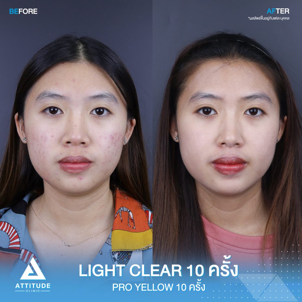 รีวิวรักษาสิว รีวิวรักษาสิวครบวงจร โปรแกรม Light Clear 7 ขั้นตอน จำนวน 10 ครั้ง และเลเซอร์ Pro Yellow รักษารอยแดง สิวอักเสบโดยเฉพาะ จำนวน 10 ครั้ง ของคุณแคท สิวหายเกลี้ยง หน้ากลับมาเนียนใส มั่นใจสุดๆ