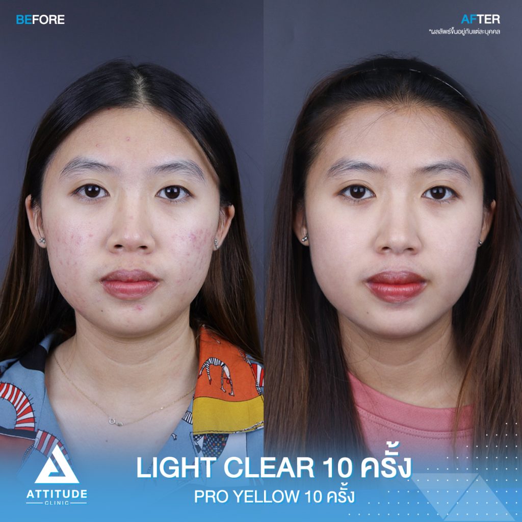 รีวิวรักษาสิวครบวงจร โปรแกรม Light Clear 7 ขั้นตอน จำนวน 10 ครั้ง และเลเซอร์ Pro Yellow รักษารอยแดง สิวอักเสบโดยเฉพาะ จำนวน 10 ครั้ง ของคุณแคท สิวหายเกลี้ยง หน้ากลับมาเนียนใส มั่นใจสุดๆ