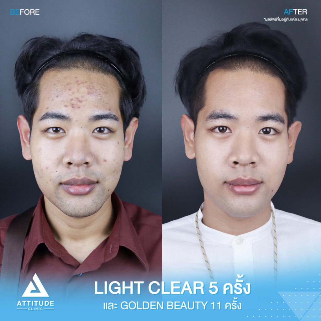 รีวิวรักษาสิว สิว! รอยสิว! หายได้ที่แอททิจูด รีวิวรักษาสิวด้วยการฉายแสงโปรแกรม Light Clear 7 ขั้นตอน จำนวน 5 ครั้ง ทรีทเมนท์บำรุงผิว Golden Beauty จำนวน 11 ครั้ง ของน้องชูศิลป์