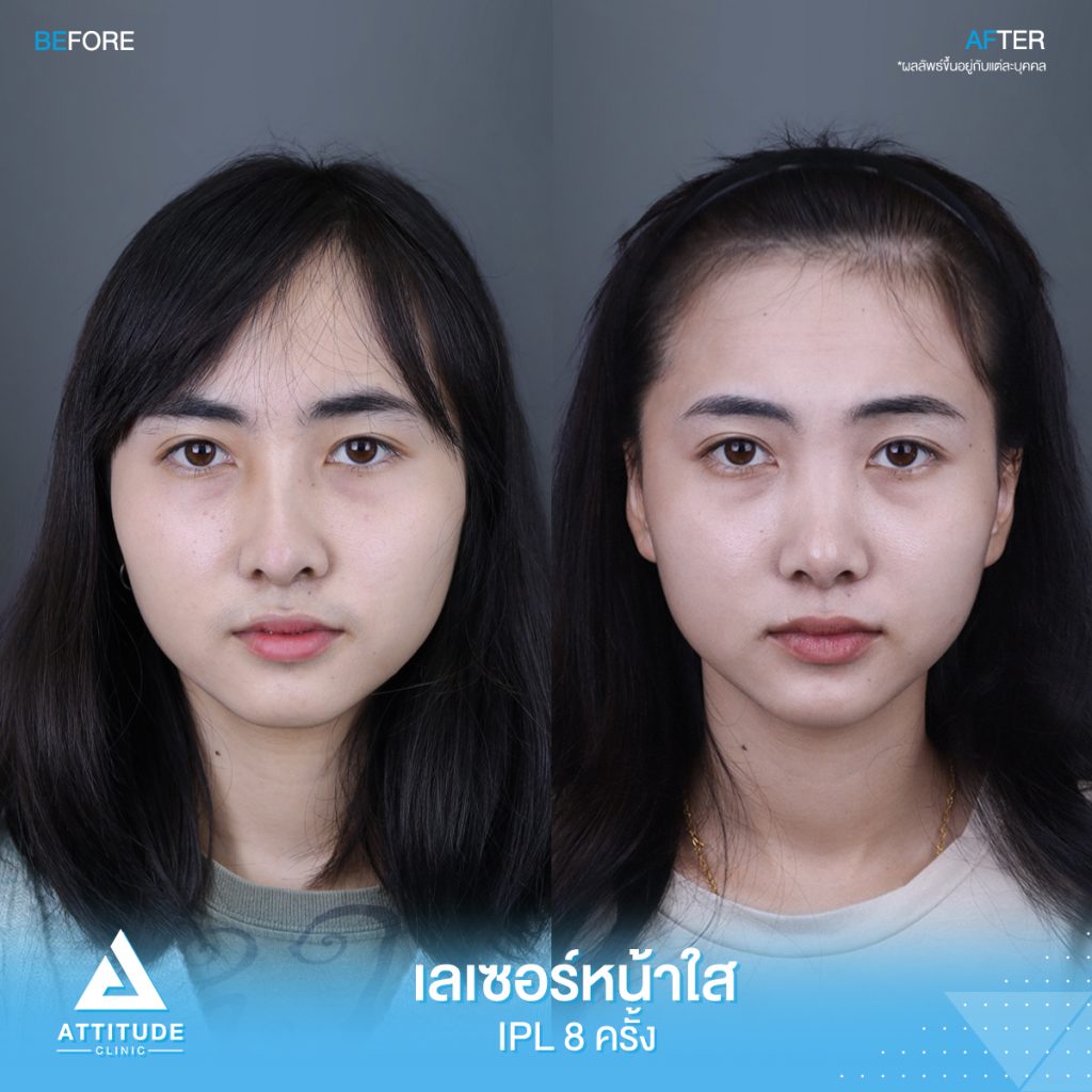 รีวิวเลเซอร์หน้าใส Cellec V IPL จำนวน 8 ครั้ง ของน้องเบนซ์ มีปัญหาผิวหมองคล้ำ รอยสิว จุดด่างดำ หลังทำเลเซอร์ตอนนี้หน้าใสวิ้ง ผิวเรียบเนียนขึ้น มั่นใจขึ้นสุดๆ