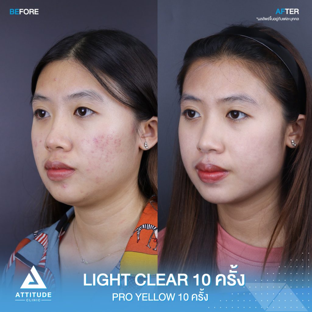 รีวิวรักษาสิวครบวงจร โปรแกรม Light Clear 7 ขั้นตอน จำนวน 10 ครั้ง และเลเซอร์ Pro Yellow รักษารอยแดง สิวอักเสบโดยเฉพาะ จำนวน 10 ครั้ง ของคุณแคท สิวหายเกลี้ยง หน้ากลับมาเนียนใส มั่นใจสุดๆ