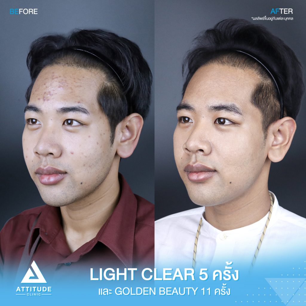 รีวิวรักษาสิว สิว! รอยสิว! หายได้ที่แอททิจูด รีวิวรักษาสิวด้วยการฉายแสงโปรแกรม Light Clear 7 ขั้นตอน จำนวน 5 ครั้ง ทรีทเมนท์บำรุงผิว Golden Beauty จำนวน 11 ครั้ง ของน้องชูศิลป์