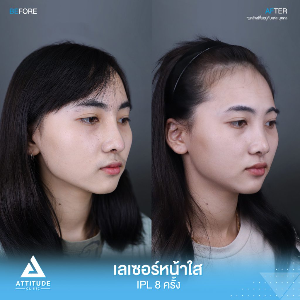 รีวิวเลเซอร์หน้าใส Cellec V IPL จำนวน 8 ครั้ง ของน้องเบนซ์ มีปัญหาผิวหมองคล้ำ รอยสิว จุดด่างดำ หลังทำเลเซอร์ตอนนี้หน้าใสวิ้ง ผิวเรียบเนียนขึ้น มั่นใจขึ้นสุดๆ