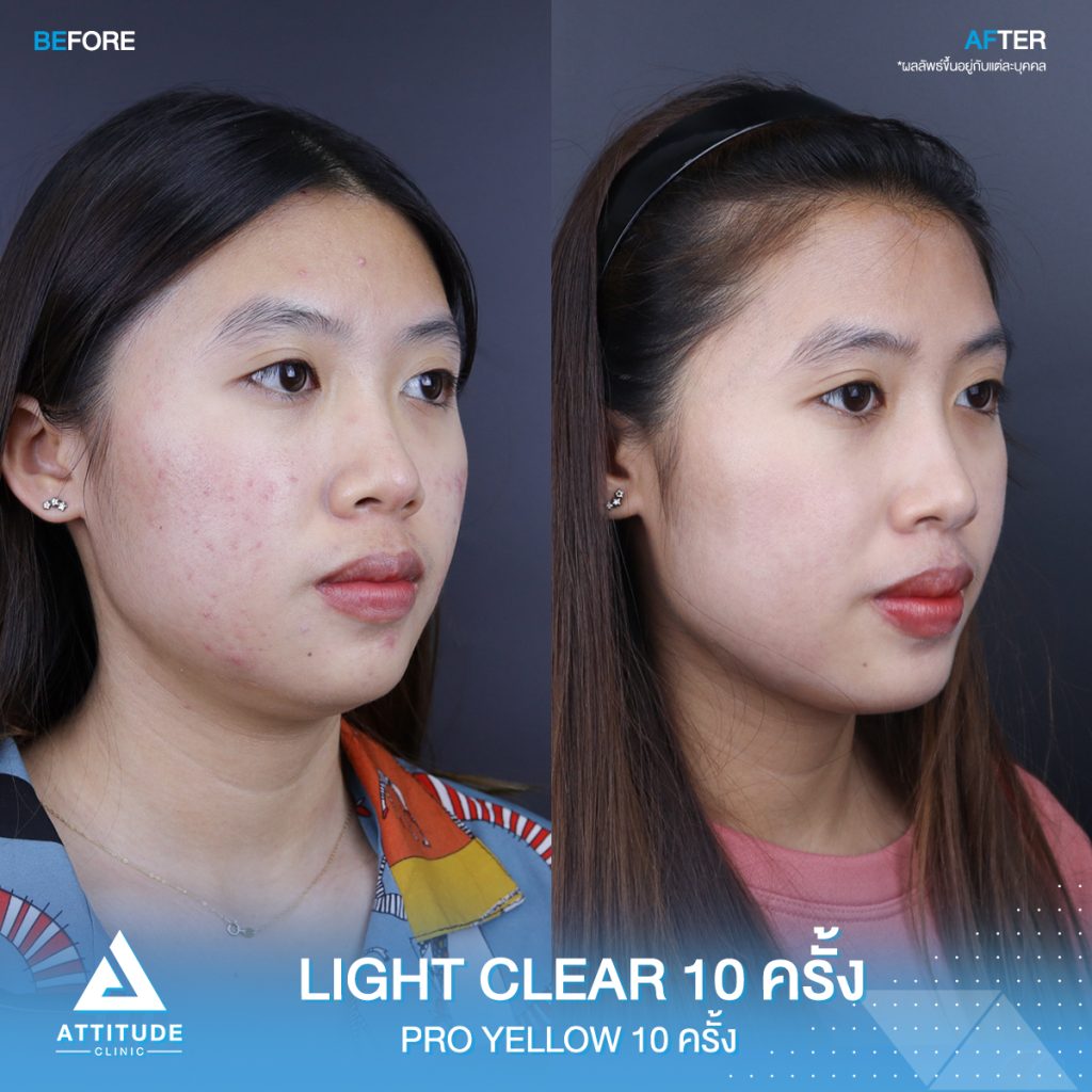 รีวิวรักษาสิว รีวิวรักษาสิวครบวงจร โปรแกรม Light Clear 7 ขั้นตอน จำนวน 10 ครั้ง และเลเซอร์ Pro Yellow รักษารอยแดง สิวอักเสบโดยเฉพาะ จำนวน 10 ครั้ง ของคุณแคท สิวหายเกลี้ยง หน้ากลับมาเนียนใส มั่นใจสุดๆ