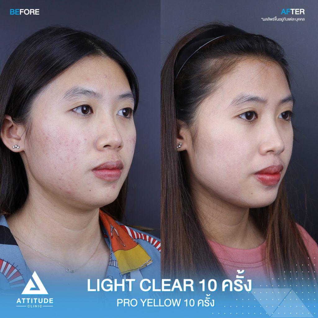 รีวิวรักษาสิวครบวงจร โปรแกรม Light Clear 7 ขั้นตอน จำนวน 10 ครั้ง และเลเซอร์ Pro Yellow รักษารอยแดง สิวอักเสบโดยเฉพาะ จำนวน 10 ครั้ง ของคุณแคท สิวหายเกลี้ยง หน้ากลับมาเนียนใส มั่นใจสุดๆ