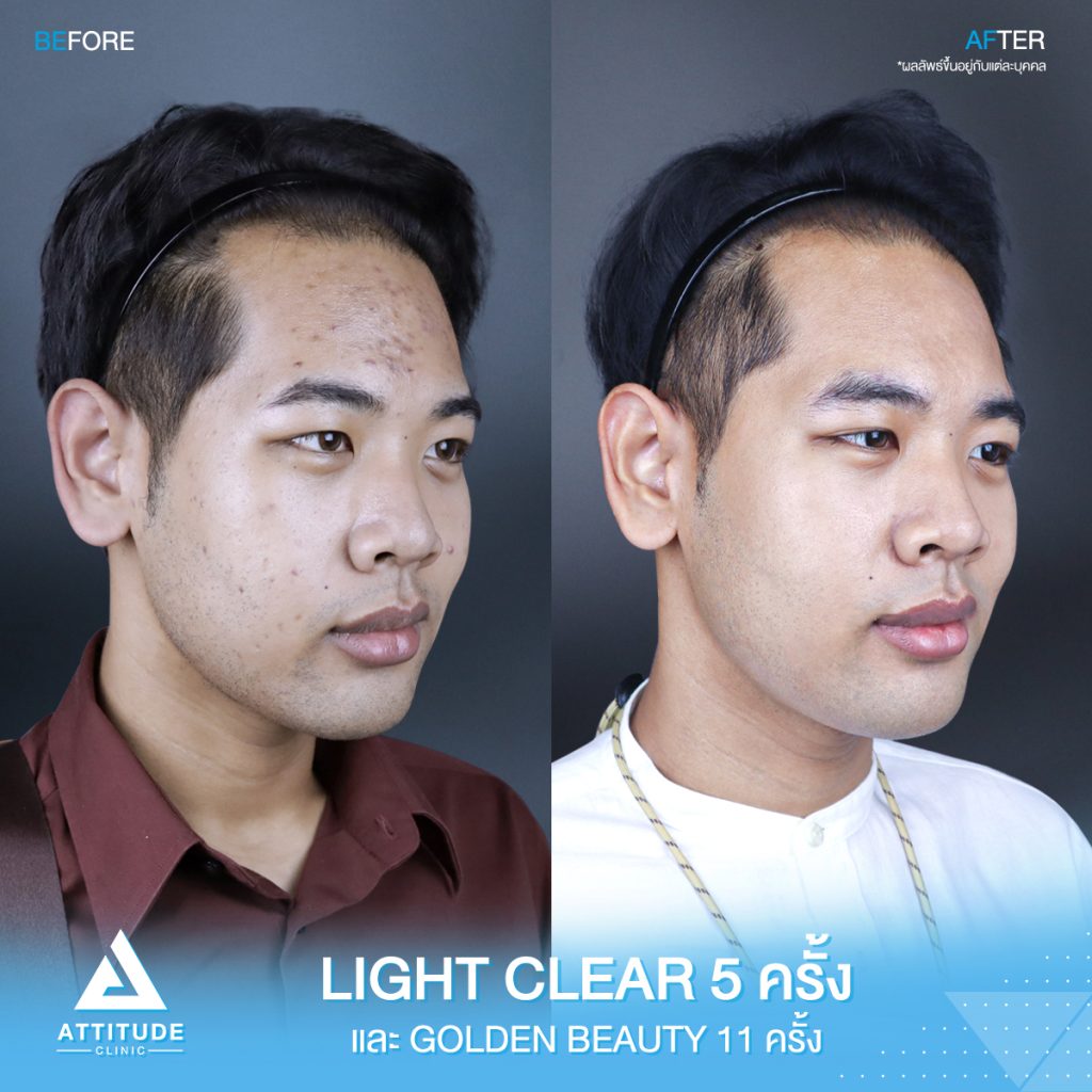 รีวิวรักษาสิว สิว! รอยสิว! หายได้ที่แอททิจูด รีวิวรักษาสิวด้วยการฉายแสงโปรแกรม Light Clear 7 ขั้นตอน จำนวน 5 ครั้ง ทรีทเมนท์บำรุงผิว Golden Beauty จำนวน 11 ครั้ง ของน้องชูศิลป์