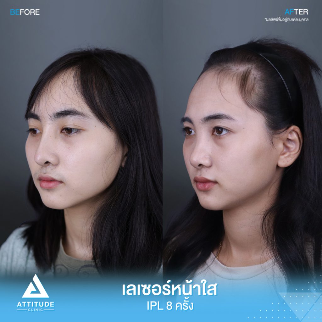 รีวิวเลเซอร์หน้าใส Cellec V IPL จำนวน 8 ครั้ง ของน้องเบนซ์ มีปัญหาผิวหมองคล้ำ รอยสิว จุดด่างดำ หลังทำเลเซอร์ตอนนี้หน้าใสวิ้ง ผิวเรียบเนียนขึ้น มั่นใจขึ้นสุดๆ