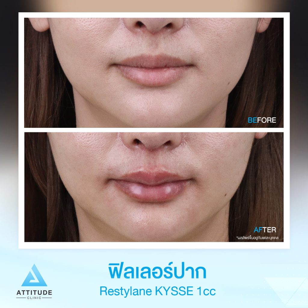 รีวิวฉีดฟิลเลอร์ปาก Restylane Kysse จำนวน 1 cc เติมเต็มปากให้อวบอิ่ม ชุ่มชื้นสุขภาพดี สวยปัง น่าจุ๊บ หันมุมไหนก็มั่นใจ ด้วยฟิลเลอร์ที่ออกแบบมาเพื่อฉีดปากโดยเฉพาะ