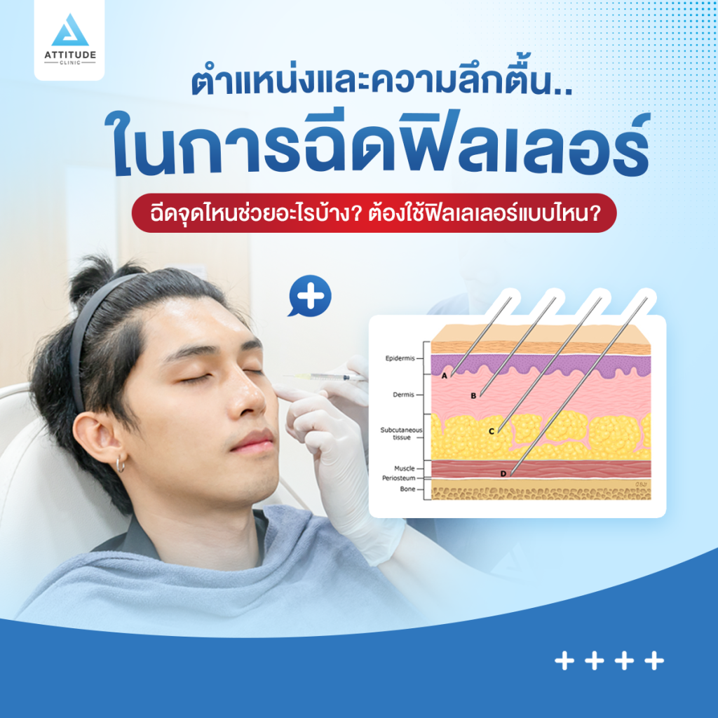 ตำแหน่งและความลึกตื้นฉีดฟิลเลอร์