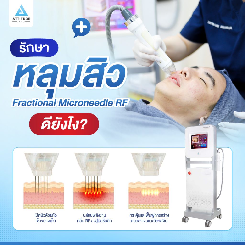 รักษาหลุมสิวแบบ Fractional Microneedle RF ดียังไง
