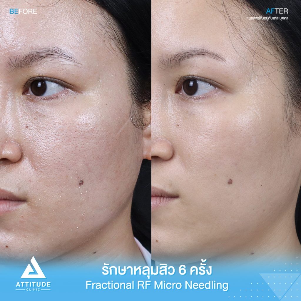 รีวิวรักษาหลุมสิว FRF Scar Fractional Micro Needle RF จำนวน 6 ครั้ง ของคุณอมรรัตน์ หลุมสิวตื้นขึ้น ผิวหน้าแน่นฟู รูขุมขนกระชับ ผิวกลับมาเรียบเนียนมั่นใจอีกครั้ง