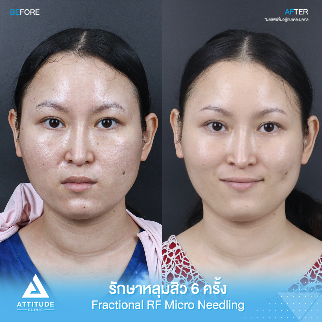 รีวิวรักษาหลุมสิว รีวิวรักษาหลุมสิว FRF Scar Fractional Micro Needle RF จำนวน 6 ครั้ง ของคุณอมรรัตน์ หลุมสิวตื้นขึ้น ผิวหน้าแน่นฟู รูขุมขนกระชับ ผิวกลับมาเรียบเนียนมั่นใจอีกครั้ง