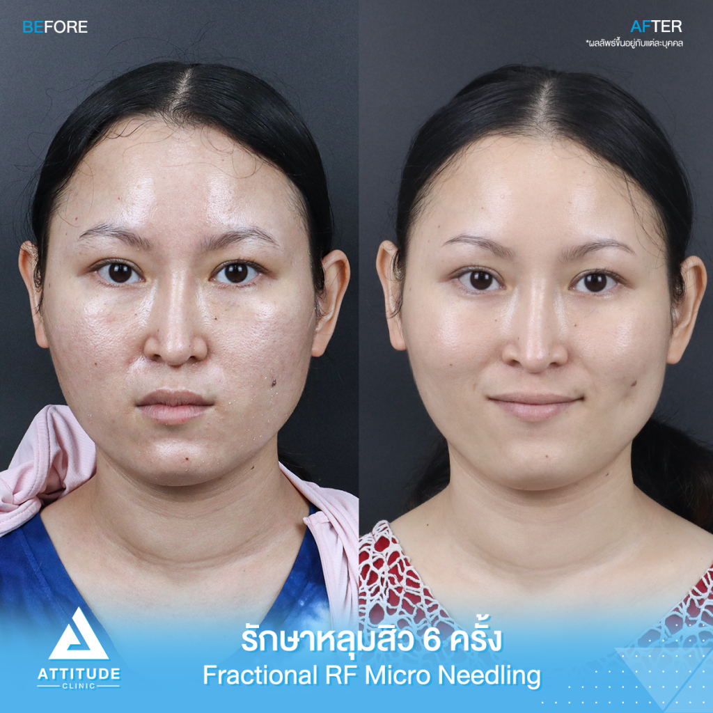 รีวิวรักษาหลุมสิว FRF Scar Fractional Micro Needle RF จำนวน 6 ครั้ง ของคุณอมรรัตน์ หลุมสิวตื้นขึ้น ผิวหน้าแน่นฟู รูขุมขนกระชับ ผิวกลับมาเรียบเนียนมั่นใจอีกครั้ง