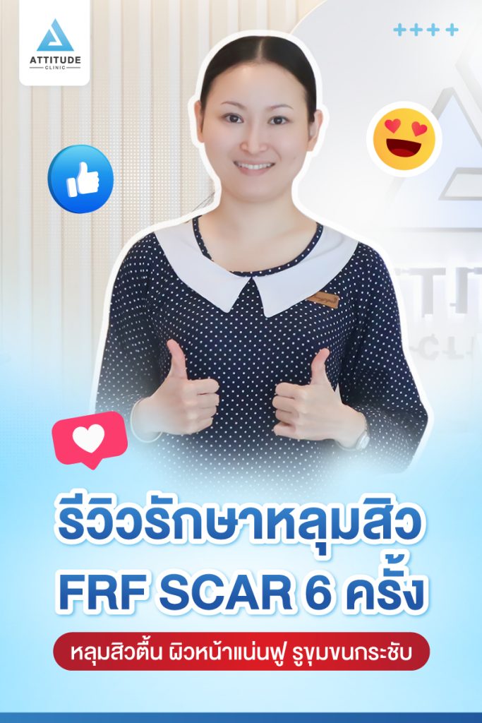 รีวิวรักษาหลุมสิว FRF Scar  Fractional Micro Needle RF จำนวน 6 ครั้ง ของคุณอมรรัตน์ หลุมสิวตื้นขึ้น ผิวหน้าแน่นฟู รูขุมขนกระชับ ผิวกลับมาเรียบเนียนมั่นใจอีกครั้ง