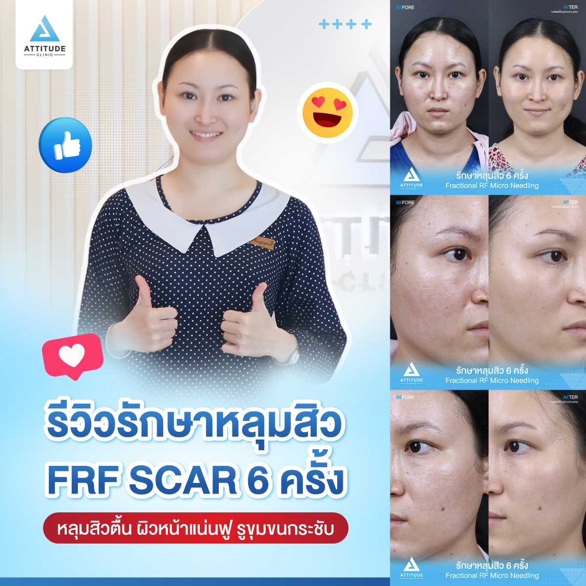 รีวิวรักษาหลุมสิว FRF Scar Fractional Micro Needle RF จำนวน 6 ครั้ง ของคุณอมรรัตน์ หลุมสิวตื้นขึ้น ผิวหน้าแน่นฟู รูขุมขนกระชับ ผิวกลับมาเรียบเนียนมั่นใจอีกครั้ง