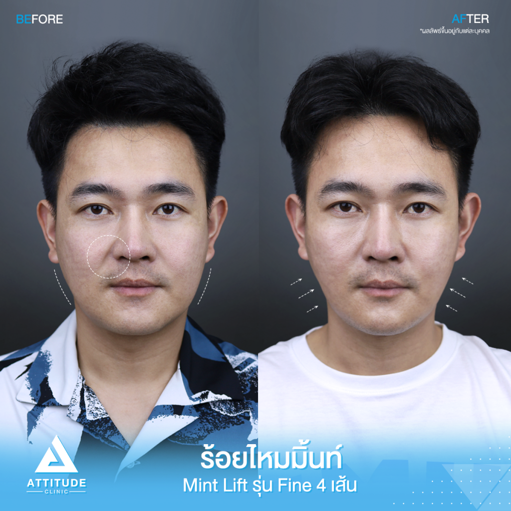 ร้อยไหมหน้าเรียว ร้อยไหมหน้าเรียว ยกจริงจังไม่ต้องผ่าตัด! รีวิวร้อยไหมมิ้นท์ Mint Lift รุ่น Fine จำนวน 4 เส้น ของคุณตี๋ ผู้บริหารแอททิจูดคลินิกของเรา มั่นใจได้เลยเจ้ายังทำ! ยก ตึง ดึง กระชับ Lower Face หน้าส่วนล่าง