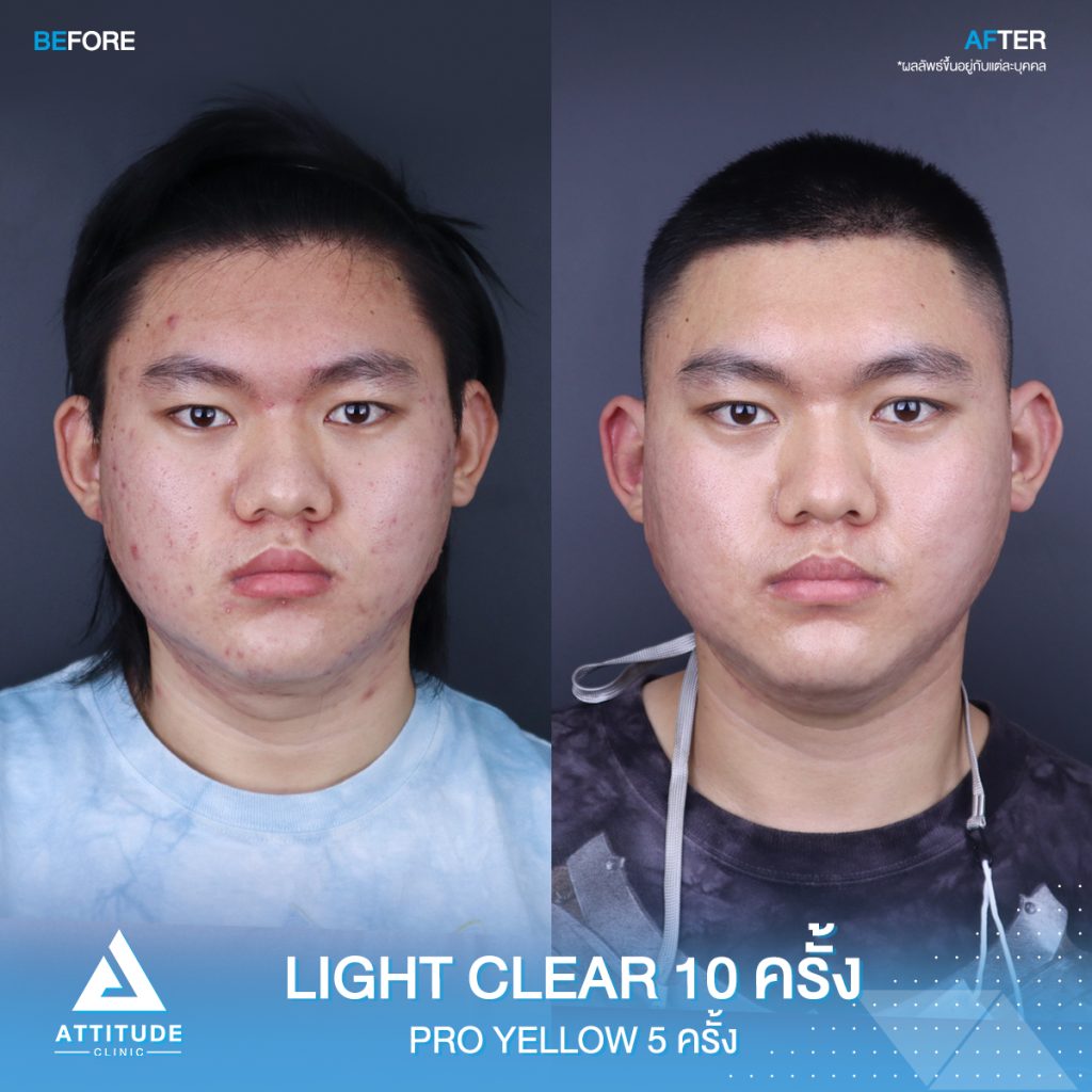 รีวิวรักษาสิวด้วยการฉายแสง สิวหาย หน้าใสวิ้ง เชื่อใจแอททิจูด รีวิวรักษาสิวด้วยการฉายแสง 7 ขั้นตอน โปรแกรม Light Clear จำนวน 10 ครั้ง และเลเซอร์ Pro Yellow ลดรอยแดงโดยเฉพาะ จำนวน 5 ครั้ง ของน้องสมบูรณ์
