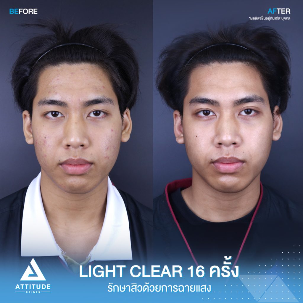 สิว! รอยสิว! หายได้ที่แอททิจูด รีวิวรักษาสิวด้วยการฉายแสงโปรแกรม Light Clear 7 ขั้นตอน จำนวน 16 ครั้ง ของน้องนนท์ ที่มีปัญหาสิวและรอยสิวจัดเต็ม หลังรักษาตอนนี้หน้าใส ผิวเรียบเนียน มั่นใจขึ้นสุดๆ