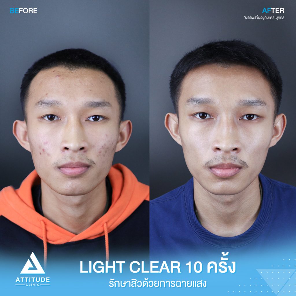 เปลี่ยนหน้าสิวเป็นหน้าใส รีวิวรักษาสิวด้วยการฉายแสง โปรแกรม Light Clear 7 ขั้นตอน จำนวน 10 ครั้ง น้องภัครพงษ์ มีปัญหาสิวและรอยสิวจัดเต็ม หลังรักษาสิวตอนนี้หน้าใสขึ้น ผิวเรียบเนียน มั่นใจขึ้นสุดๆ